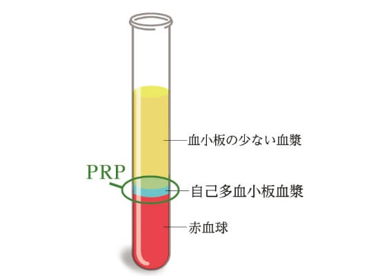 PRP療法とは